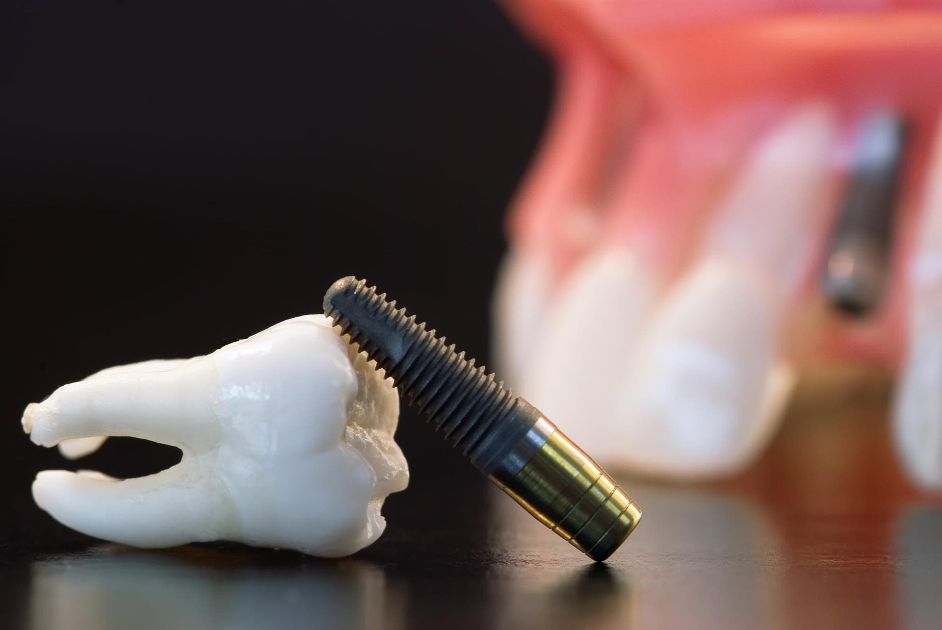 Clínica Dental Vila Real - Implantes dentales